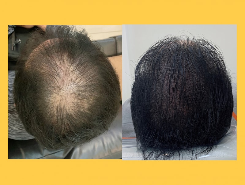 頭皮のタトゥーと治療して髪の毛が生えている体験談#オレ頭皮センター