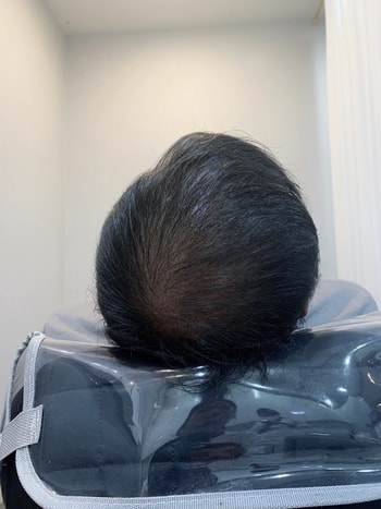 두피문신 받고난 후