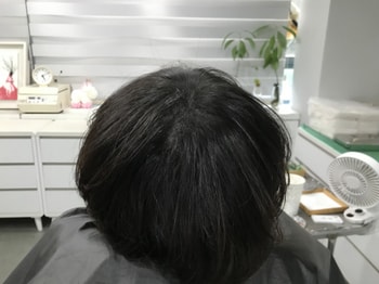 시술 후3