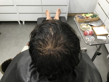 시술 전4