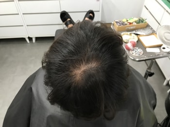 시술 전2