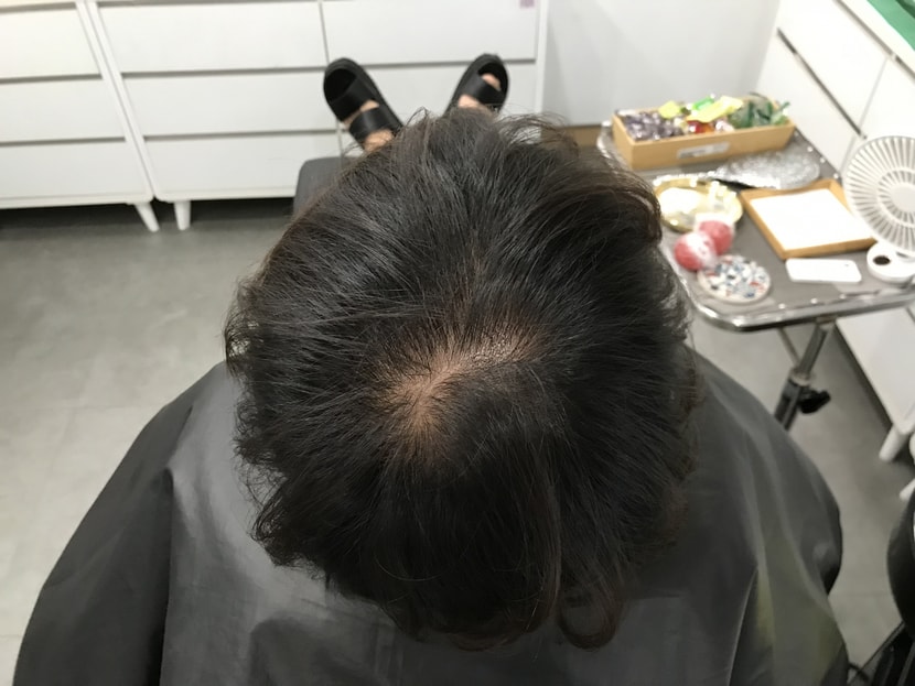 시술 전2