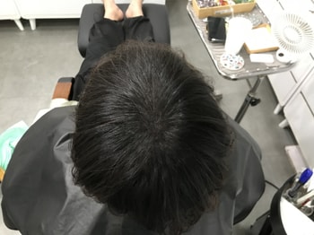 시술 후4
