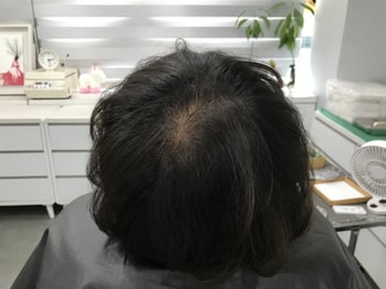 시술 전1