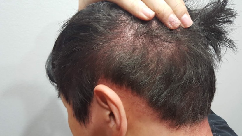 옆머리와 뒷부분 after