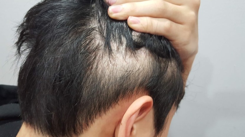 옆머리부분 before