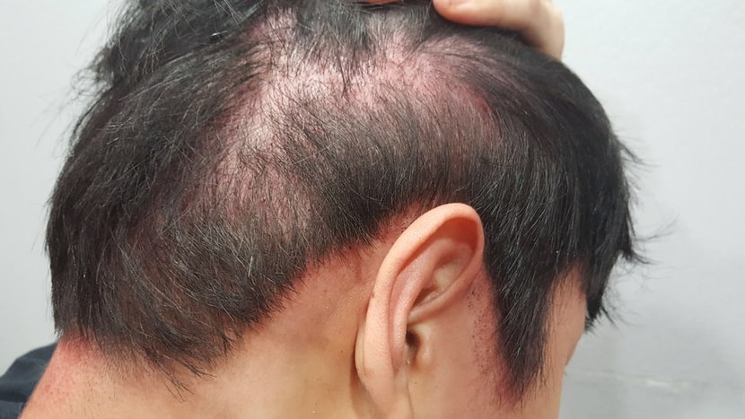 옆머리부분 after