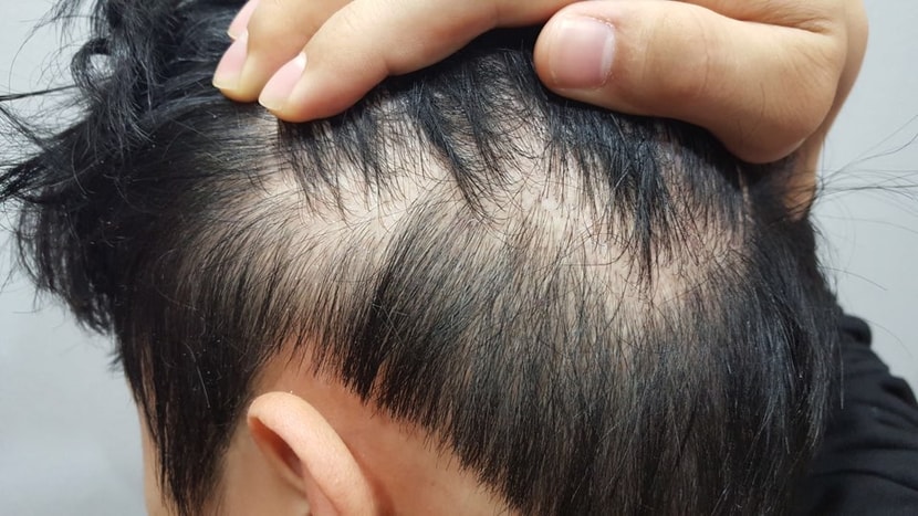 옆머리와 뒷부분 before