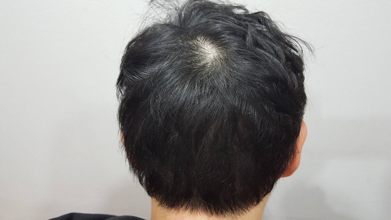在江南米开朗医院非切开疤痕部分纹了头皮。