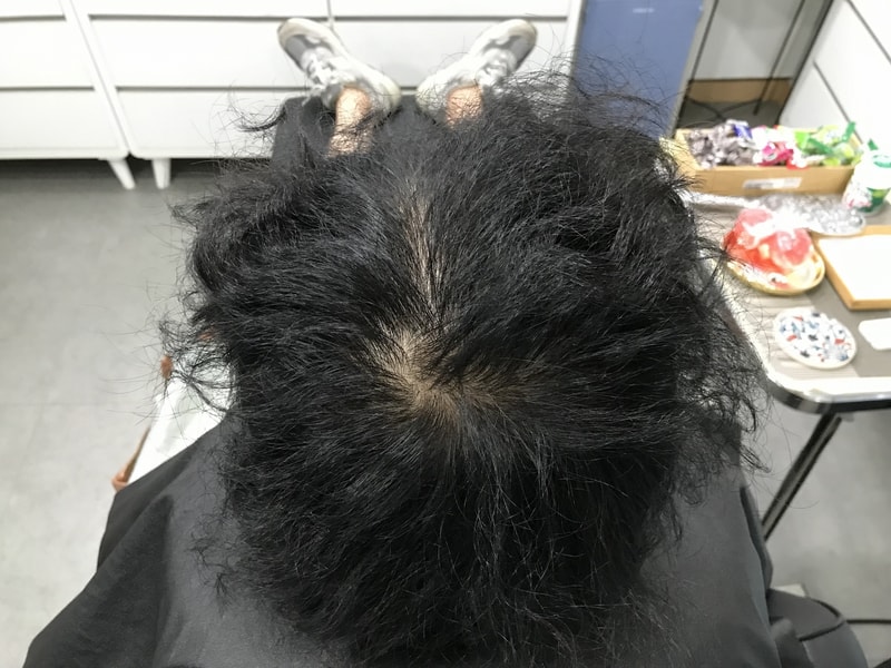 スジチム微細ドットの1次体験談です。