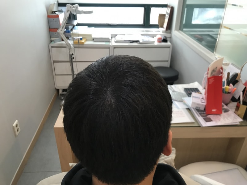 [연세미다인] 두피문신 그라데이션 기법 1년 후기