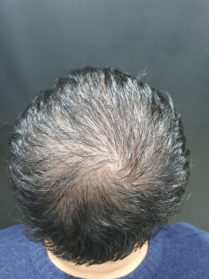 1차 두피문신 했습니다