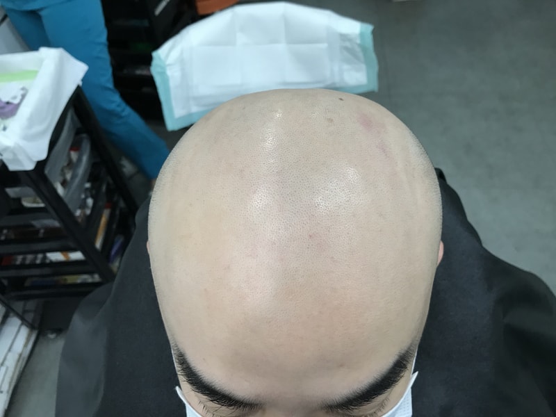 민머리 두피문신 4차까지 후기