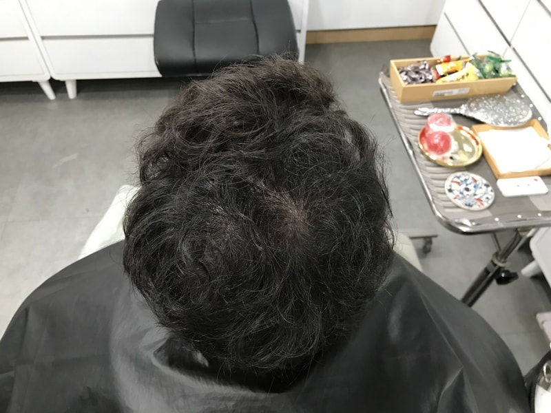 [頭皮タトゥー] ヨンセミダイン グラデーション ドット 頭皮タトゥー 1次体験談