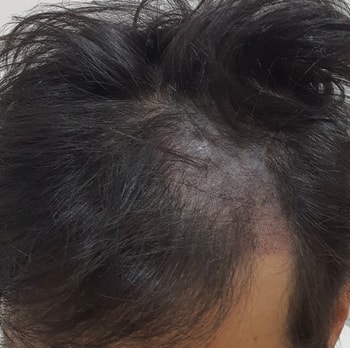 두피문신 후