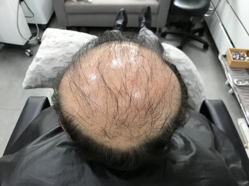연세 미다인 (두피문신 후기)