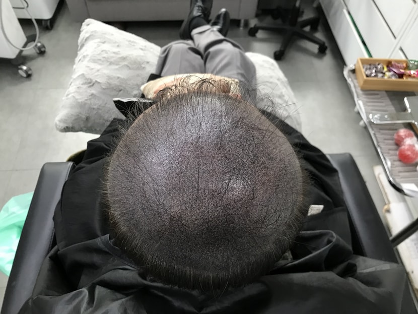 두피문신후 사진입니다~