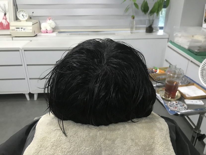 시술후