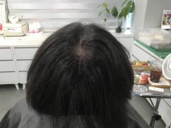 시술전