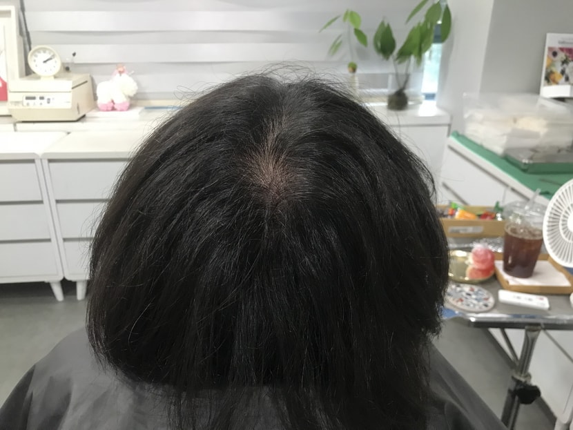 시술전