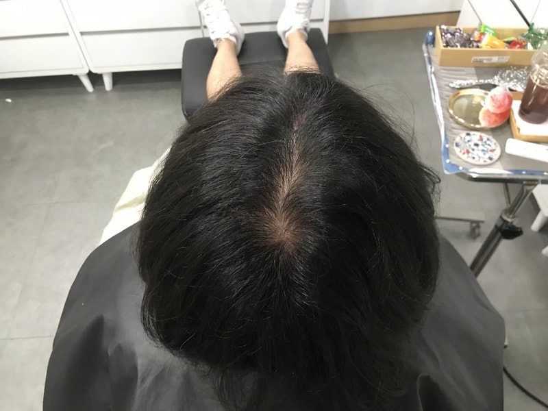 ヨンセミダイン頭皮タトゥーの体験談です~~