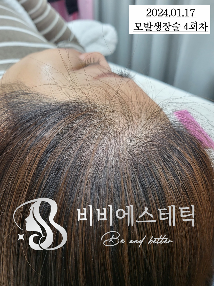 주1회케어 30대중반여성(헤어라인 M자탈모)-1/17