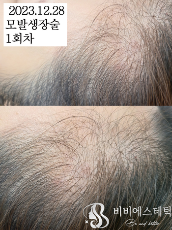 주1회케어 30대중반여성(헤어라인 M자탈모)-12/28