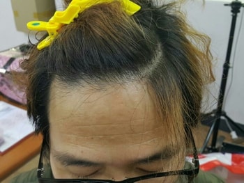 엠자 증모술(우측) 좌우 비교