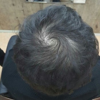 40대 300모 증모후