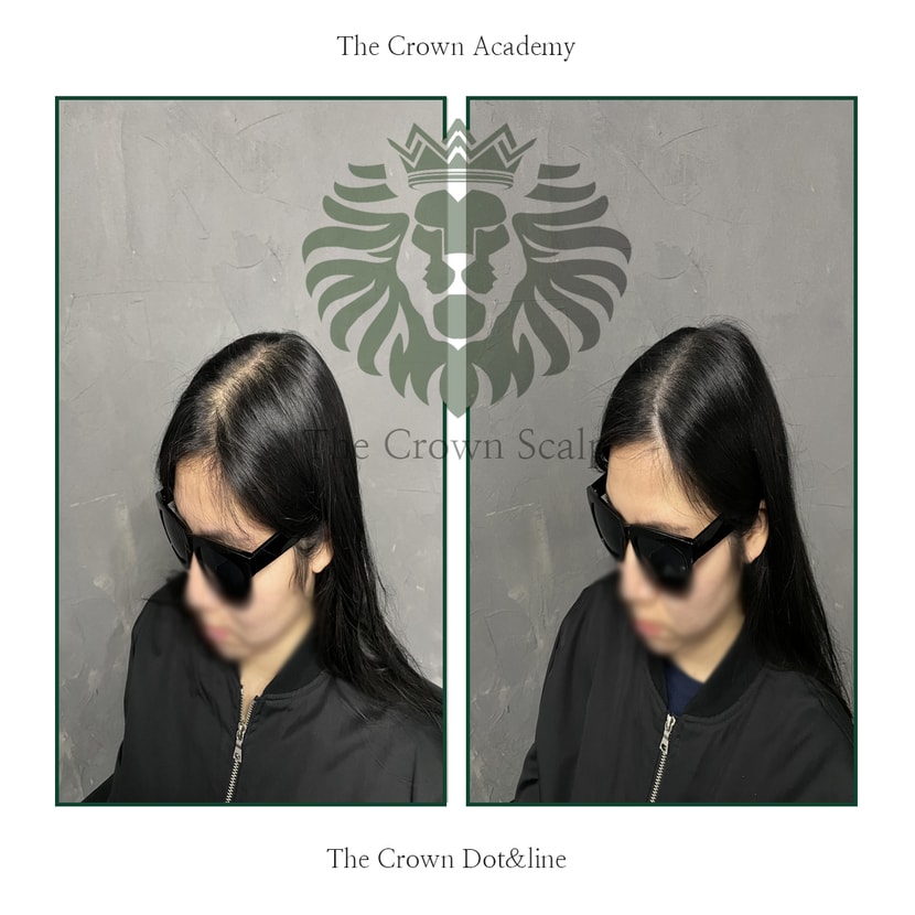 가르마밀도보강