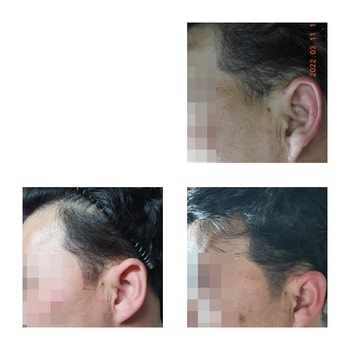 모발 이식 후 낮은 밀도 두피문신으로 커버(각진 구레나룻을 샤프하게 디자인 후 지우고 커버)