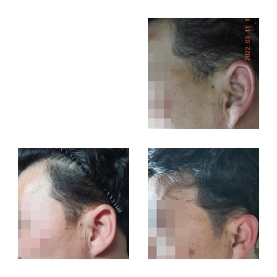 모발 이식 후 낮은 밀도 두피문신으로 커버(각진 구레나룻을 샤프하게 디자인 후 지우고 커버)