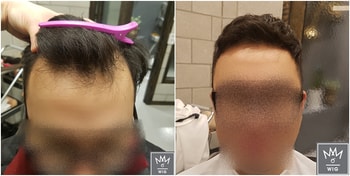 예)엠자 탈모로 인하여 커트와 스타일링으로 탈모 커버하신 고객님.