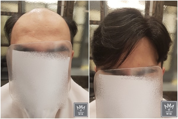 예)남성형 탈모로 인하여 맞춤가발 하신 고객님.