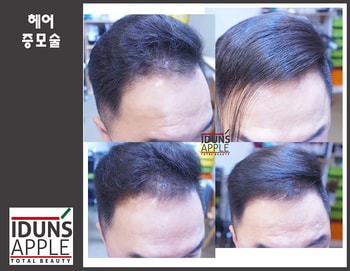 앞머리 부분 숱이 적어 600모 증모 시술한 사진