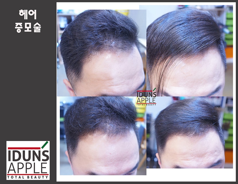앞머리 부분 숱이 적어 600모 증모 시술한 사진