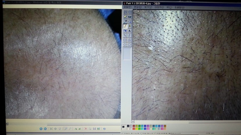 지인 사용중 45일째 사진, 탈모 20년 경과