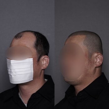 남성 삭발 시술 전후 사진
