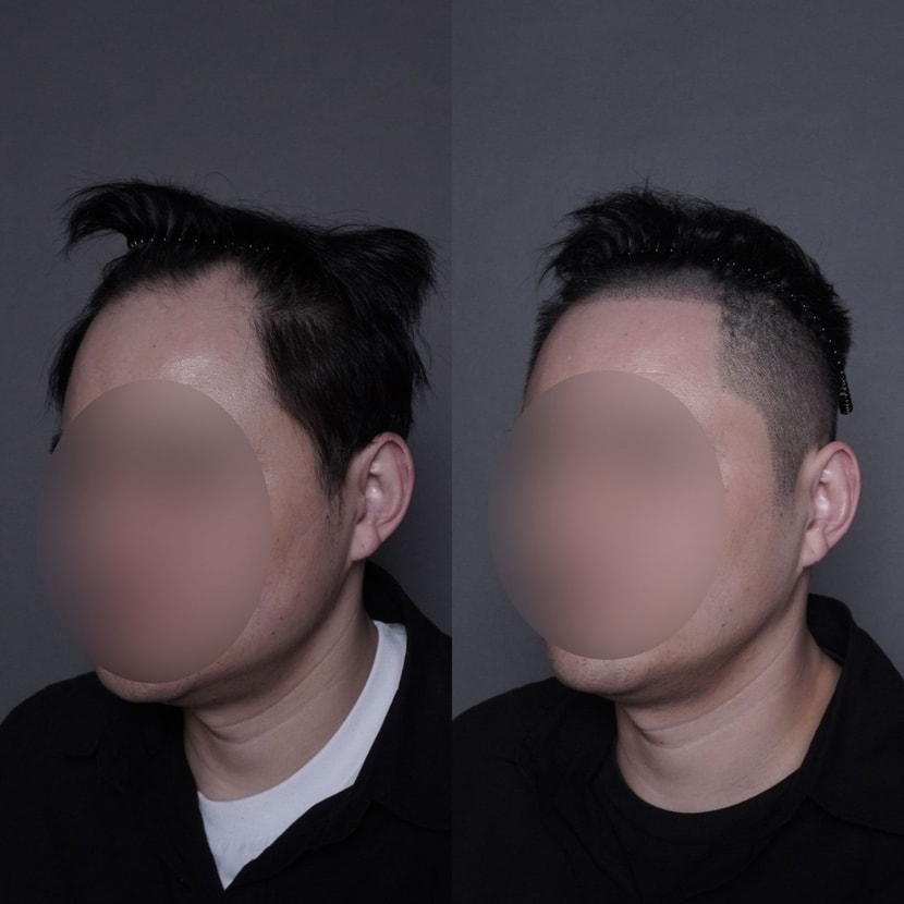 남성 옴므 시술 전후 사진