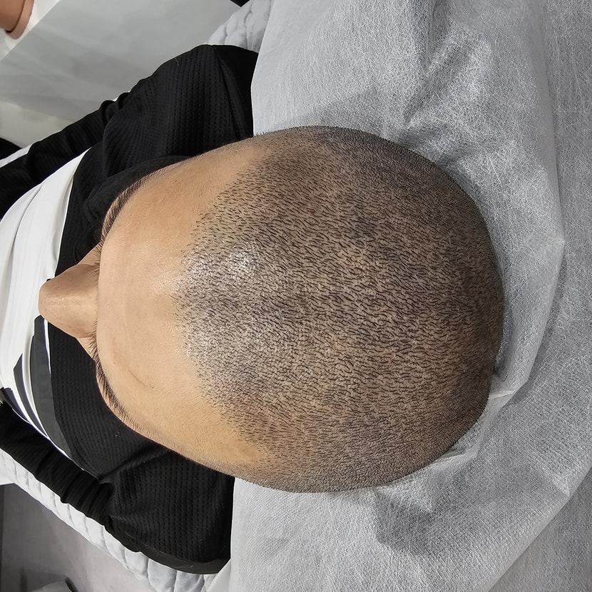 3D아트기법의 SMP두피문신