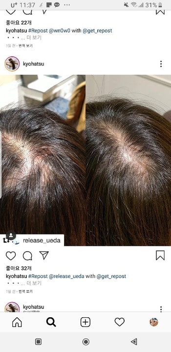 탈모치료인스타