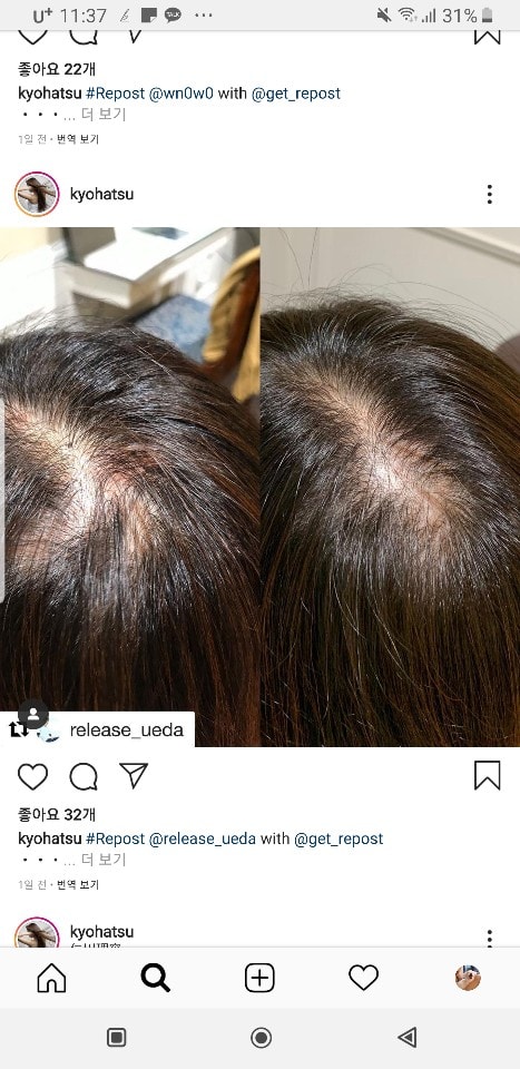 탈모치료인스타