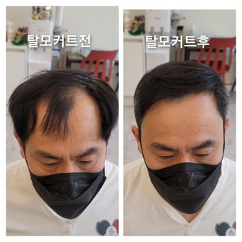 탈모 커트만으로 탈모해결
