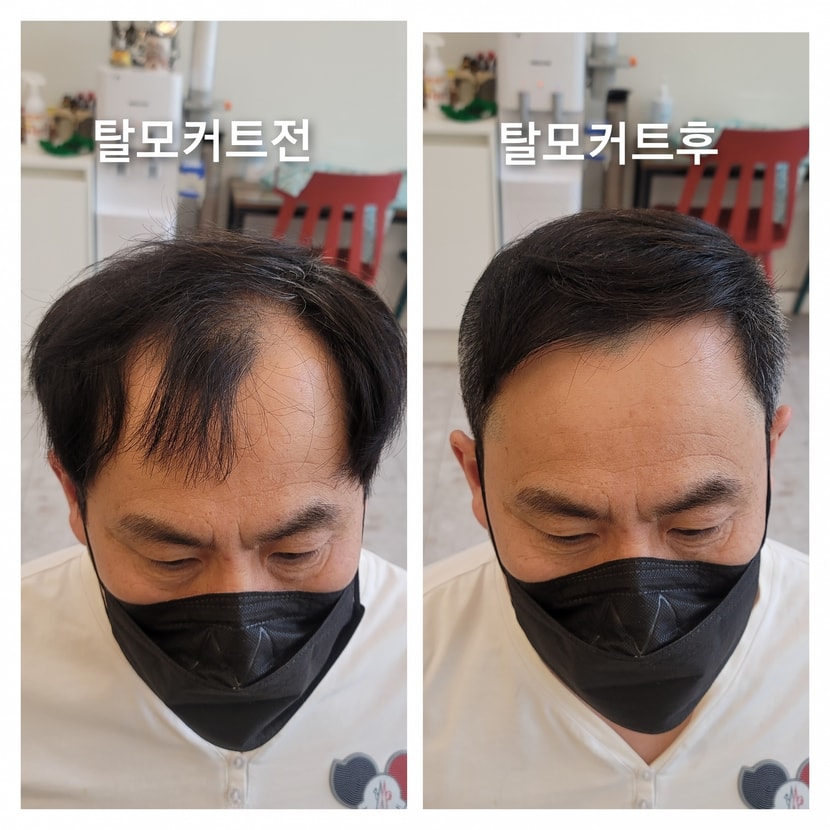 탈모 커트만으로 탈모해결