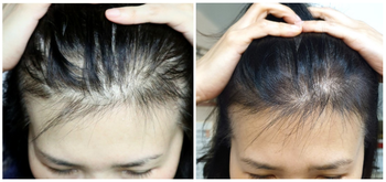 (40대 여성탈모, 3개월 사용후기)
