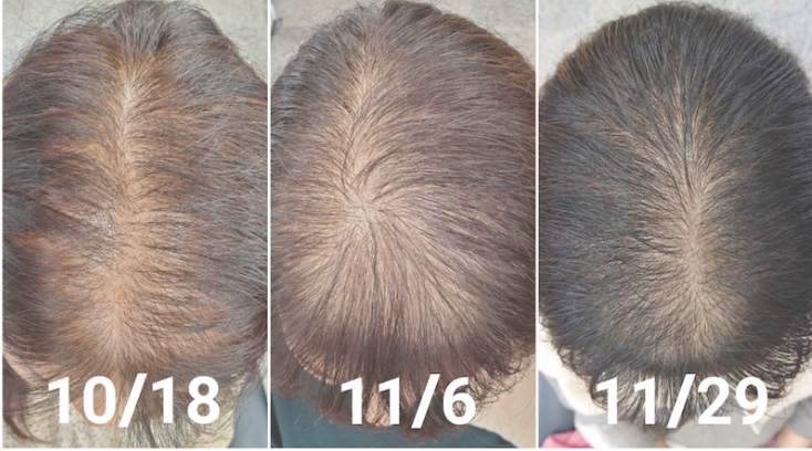 줄기세포발모제 후기(시스hsc / hsc15) - 지예가(판매처)