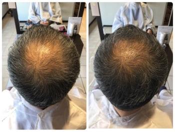 (50대 남성, 확산형 탈모 5개월 사용후기)