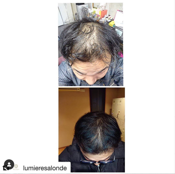 일본줄기세포 발모제 후기!! - 지예가(판매처)