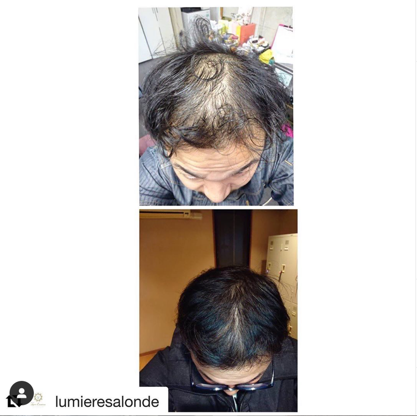 일본줄기세포 발모제 후기!! - 지예가(판매처)