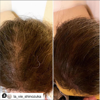 모발상태가 안좋았던 50대남성탈모